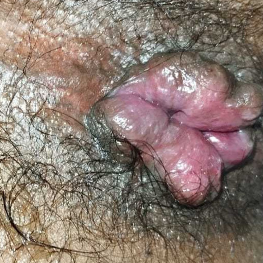  piles I Anal Fissure I Anal Fistula I Anal Bleeding I Anal pain I
