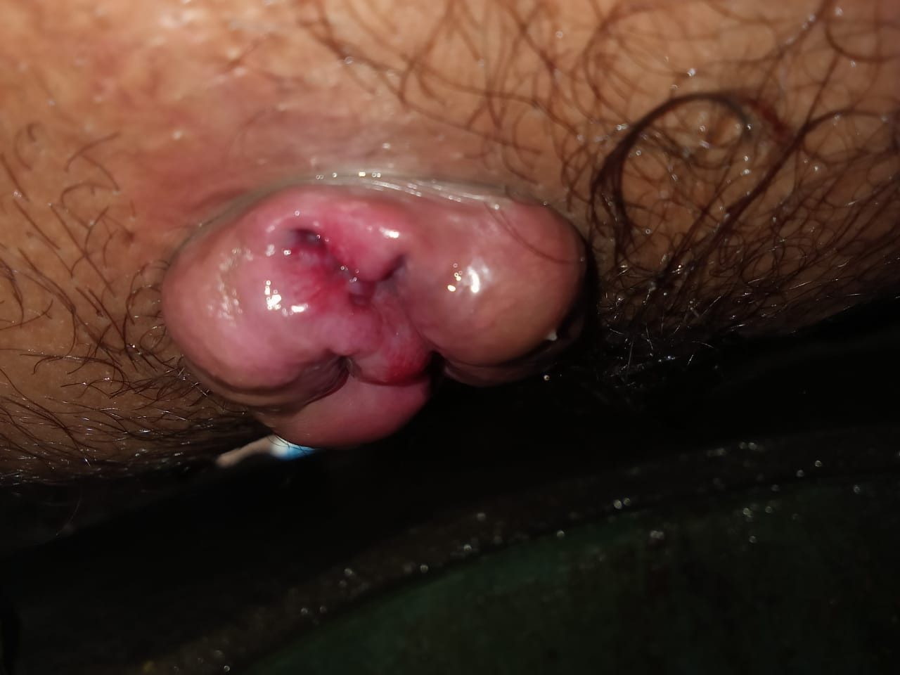  piles I Anal Fissure I Anal Fistula I Anal Bleeding I Anal pain I